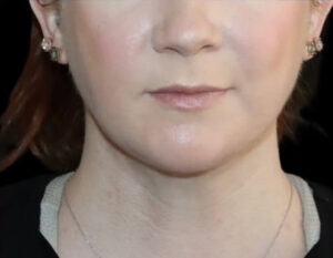 Submental Liposuction Before and After Gallery