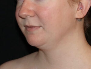 Submental Liposuction Before and After Gallery