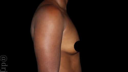 Breast Augmentation Before and After Gallery