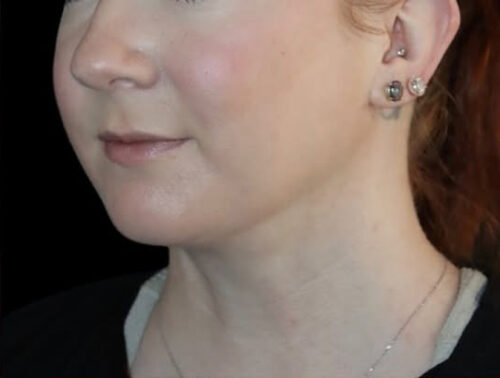 Submental Liposuction Before and After Gallery