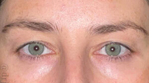 Eyelid Surgery Before and After Gallery
