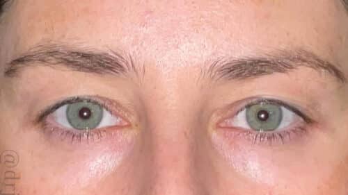Eyelid Surgery Before and After Gallery