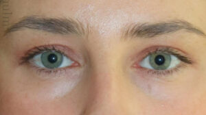Eyelid Surgery Before and After Gallery