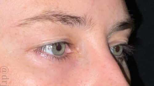 Eyelid Surgery Before and After Gallery