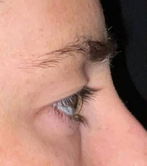 Eyelid Surgery Before and After Gallery