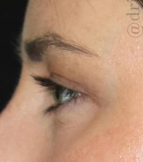 Eyelid Surgery Before and After Gallery