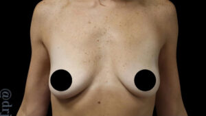 Breast Implants with Lift Before and After Gallery