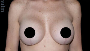Breast Implants with Lift Before and After Gallery