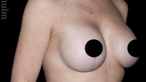 Breast Implants with Lift Before and After Gallery