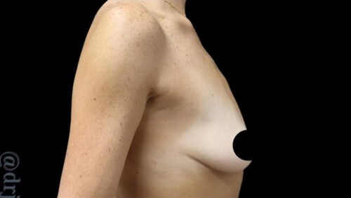 Breast Implants with Lift Before and After Gallery