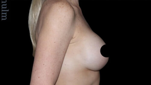 Breast Implants with Lift Before and After Gallery