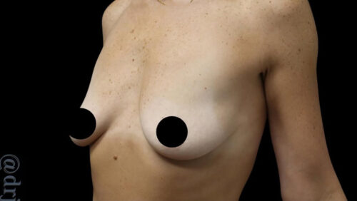Breast Implants with Lift Before and After Gallery