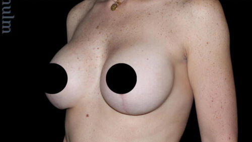 Breast Implants with Lift Before and After Gallery