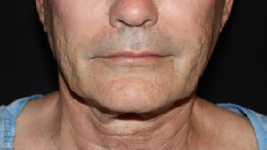 Face and Necklift Before and After Gallery