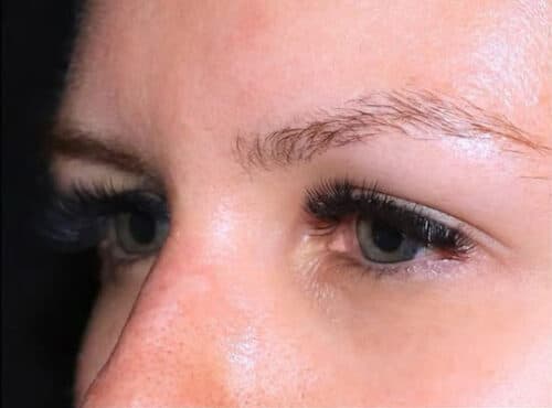 Eyelid Surgery Before and After Gallery