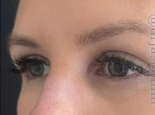 Eyelid Surgery Before and After Gallery