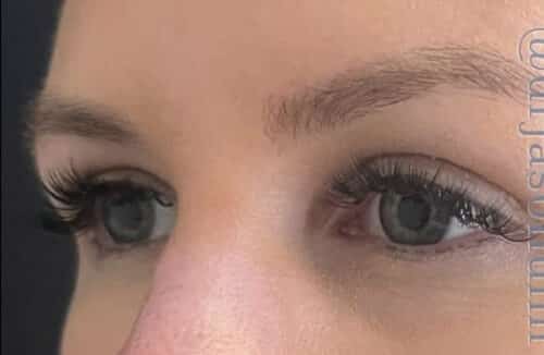Eyelid Surgery Before and After Gallery