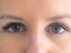 Eyelid Surgery Before and After Gallery