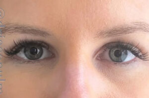 Eyelid Surgery Before and After Gallery