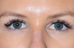 Eyelid Surgery Before and After Gallery