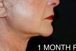 Face and Necklift Before and After Gallery