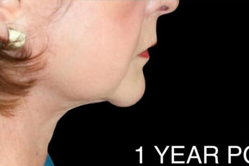 Face and Necklift Before and After Gallery