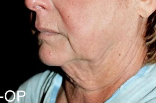Face and Necklift Before and After Gallery