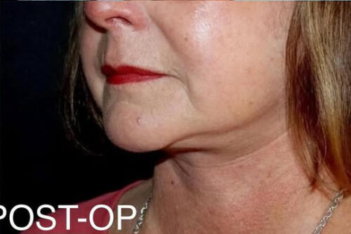 Face and Necklift Before and After Gallery
