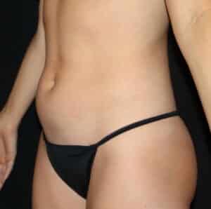 Liposuction Before and After Gallery