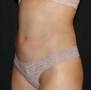 Liposuction Before and After Gallery