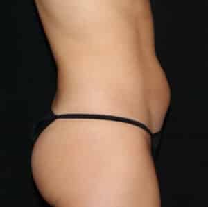 Liposuction Before and After Gallery