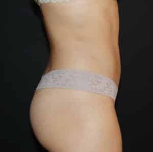 Liposuction Before and After Gallery