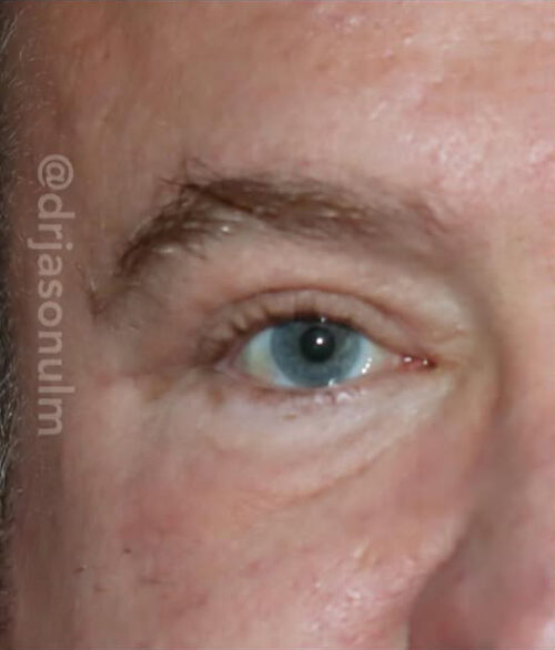 Eyelid Surgery Before and After Gallery