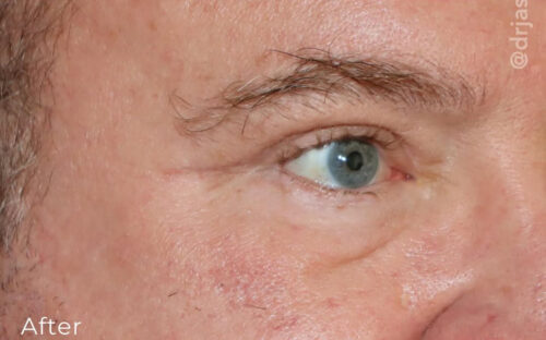 Eyelid Surgery Before and After Gallery