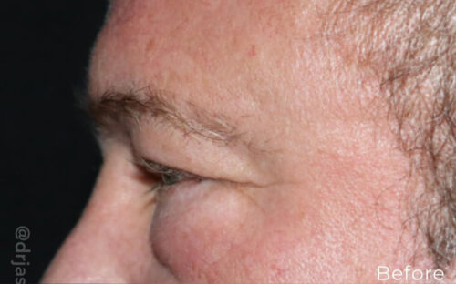 Eyelid Surgery Before and After Gallery