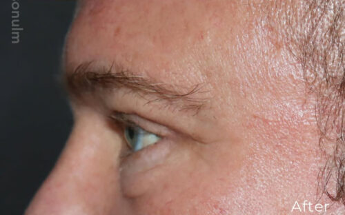 Eyelid Surgery Before and After Gallery
