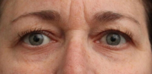 Eyelid Surgery Before and After Gallery
