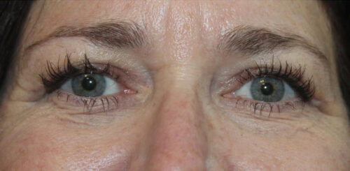 Eyelid Surgery Before and After Gallery