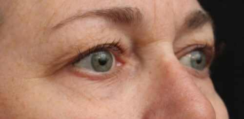 Eyelid Surgery Before and After Gallery