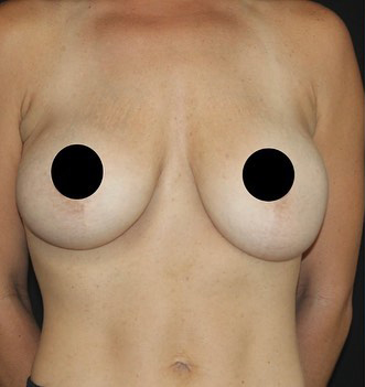 Breast Augmentation Before and After Gallery