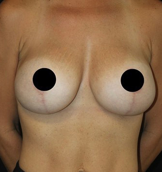Breast Augmentation Before and After Gallery