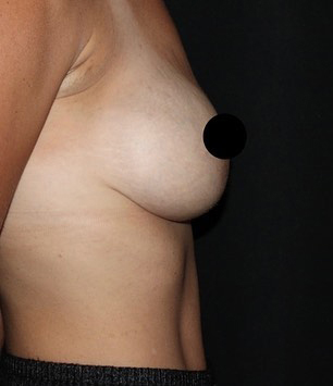 Breast Augmentation Before and After Gallery