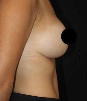 Breast Augmentation Before and After Gallery