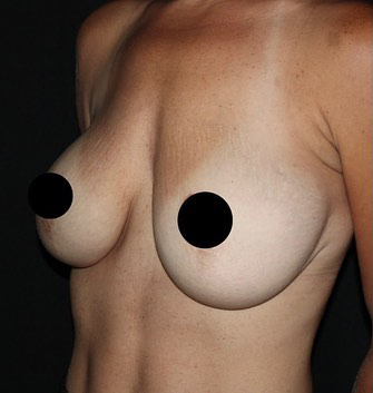 Breast Augmentation Before and After Gallery