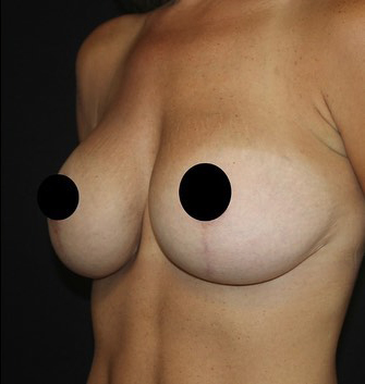 Breast Augmentation Before and After Gallery
