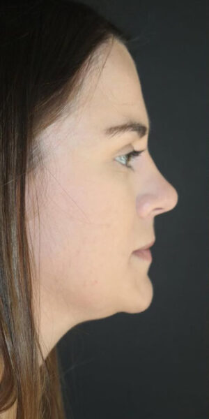 Juvederm Volbella Before and After Gallery