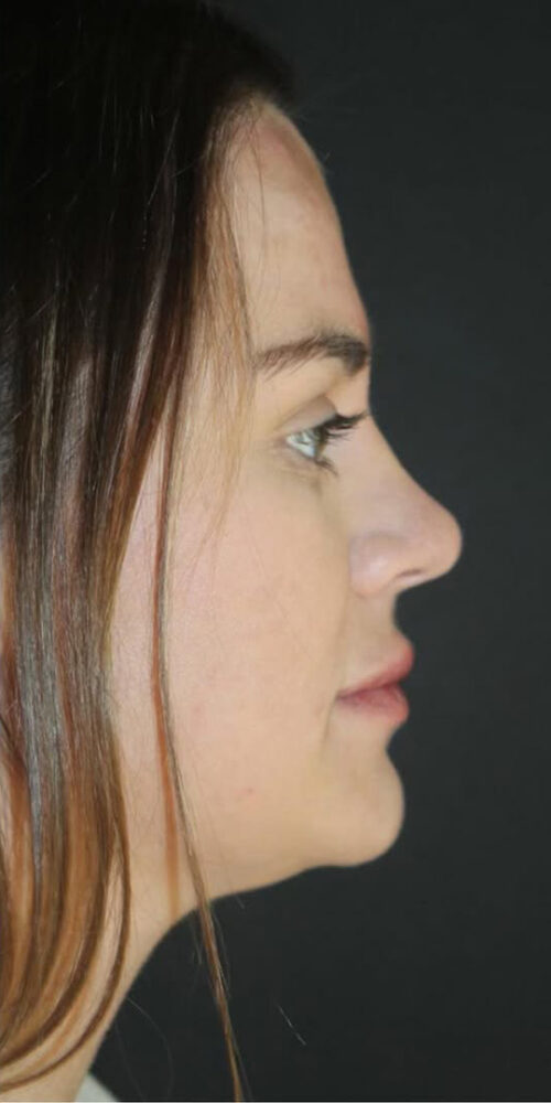 Juvederm Volbella Before and After Gallery