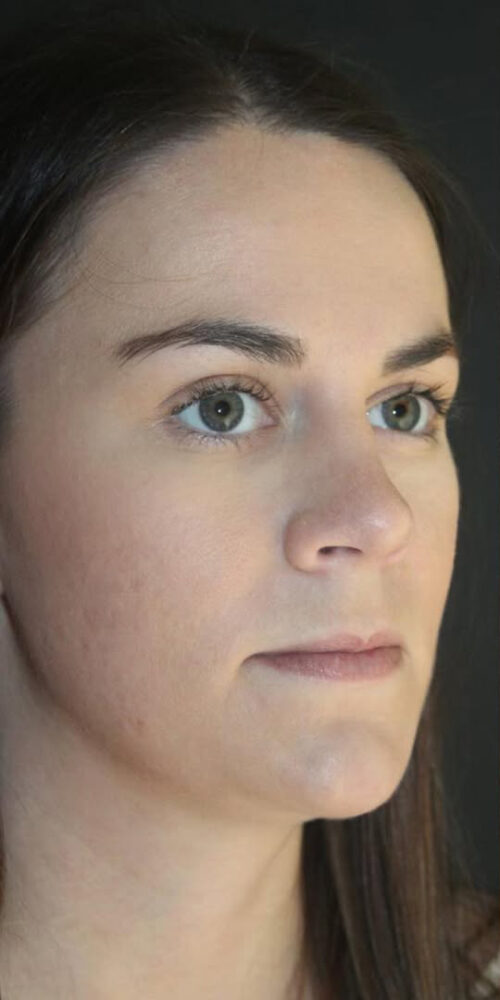 Juvederm Volbella Before and After Gallery