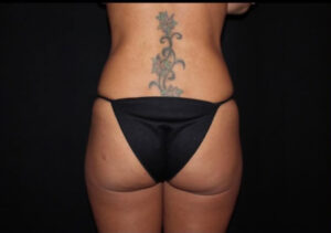 Brazilian Butt Lift Before and After Gallery