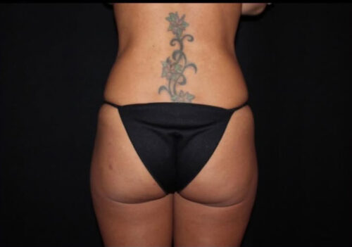 Brazilian Butt Lift Before and After Gallery